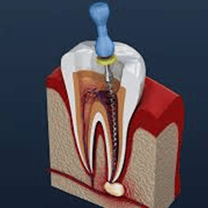 root canal treatment