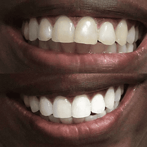 teeth whitening